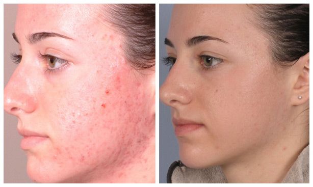 laser acne treatment
