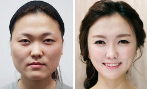 jawline reduction plastic surgery