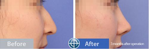 Hump nose correction before and after photo in korea