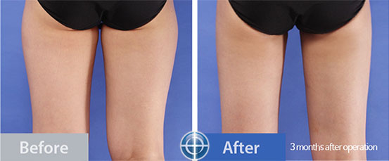 thigh-liposuction-before-and-after-photo-in-Korea