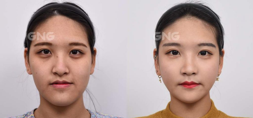 Everything You Need To Know About Double Jaw Surgerymedisetter