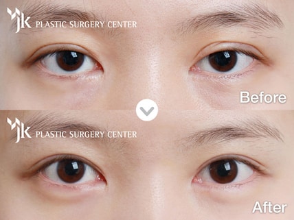 Cara Memperbaiki Kelopak Mata Anda Yang Terkulai Murung Ptosis Medisetter